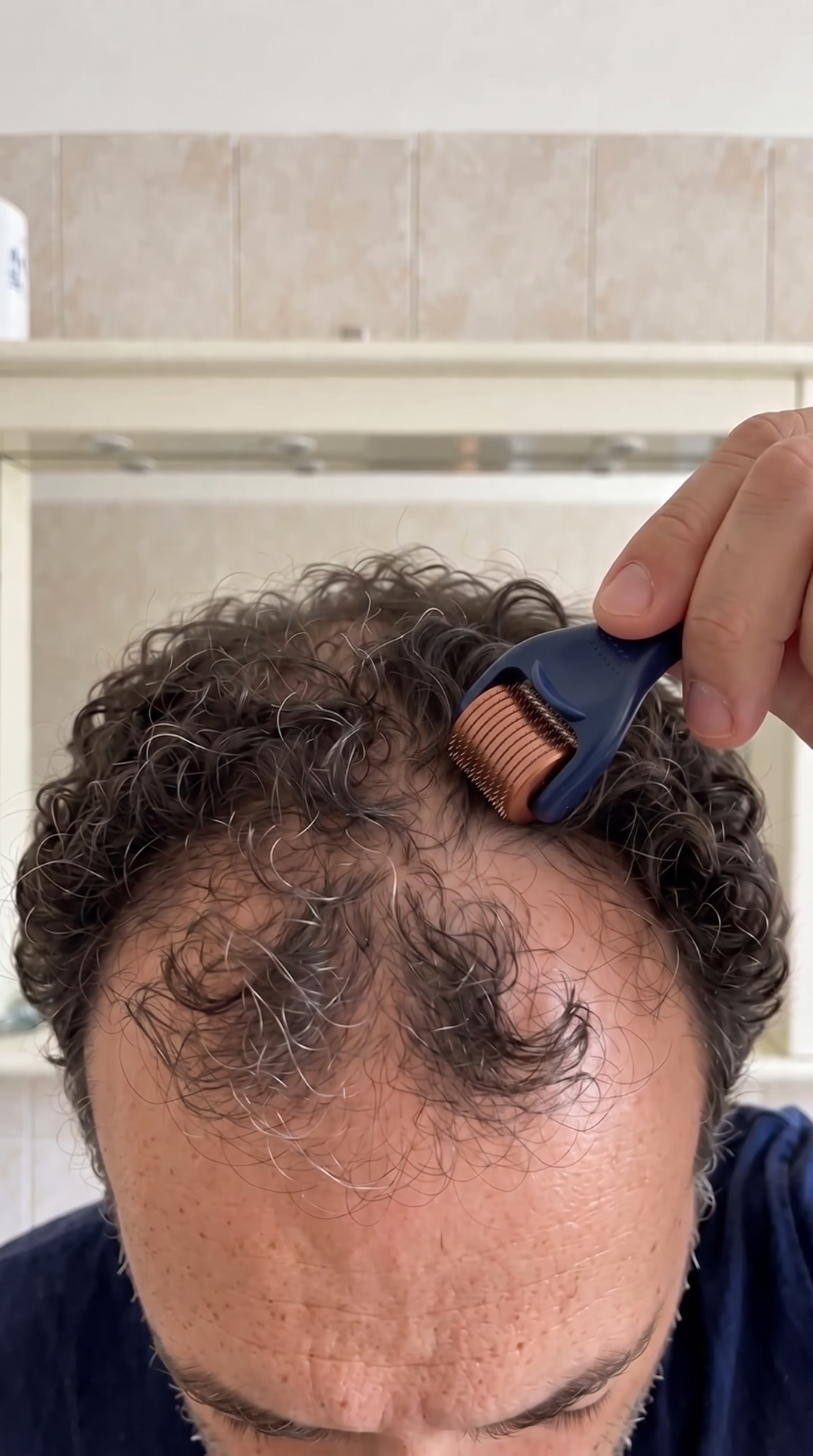 Derma roller navy e rame in uso sul cuoio capelluto