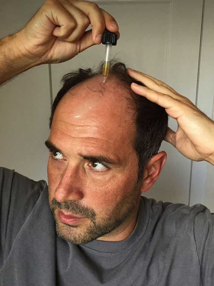 Uomo applica il Siero Attivatore BeardGrowz col contagocce sul cuoio capelluto
